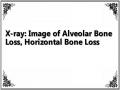 X-ray: Image of Alveolar Bone Loss, Horizontal Bone Loss