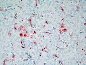 Kháng nguyên ở não nhuộm IHC Kháng nguyên ở phổi nhuộm IHC Kháng nguyên ở 3