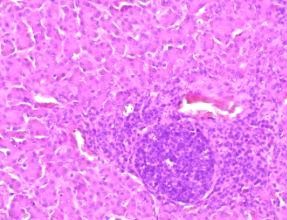 Kết quả xét nghiệm vi thể khá tương đồng với kết quả xét nghiệm RRT PCR 2