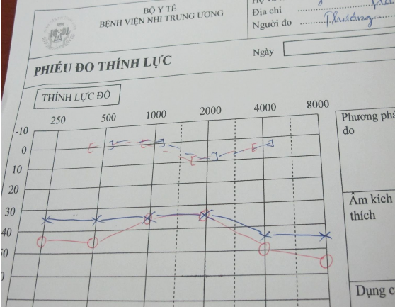 Hình 2 Hình ảnh thính lực đồ điếc dẫn truyền qua đo đơn âm Cần hướng 2