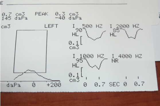 Hình 4 Phản xạ cơ bàn đạp và Nhĩ lượng Ngưỡng phản xạ cơ bàn đạp 2