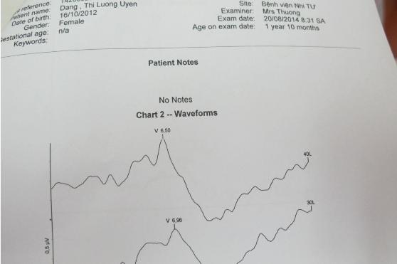 Hình 5 Hình ảnh kết quả đo ABR Nghiệm pháp này đo đáp ứng của dây thần kinh 3