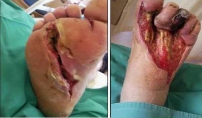 Hình 1 6 Thối chân do đèn tiết kiệm điện Con người khi tiếp xúc với chất 1