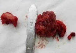 MỘT SỐ HÌNH ẢNH MINH HỌA A B C D E F Bệnh nhân nữ 44 tuổi MP đau nhức lồi 1