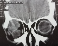 C D E F Bệnh nhân nam 41 tuổi MP lồi mắt Chẩn đoán MP U hỗn hợp tuyến lệ 10