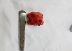 E F Bệnh nhân nam 41 tuổi MP lồi mắt Chẩn đoán MP U hỗn hợp tuyến lệ lành 11