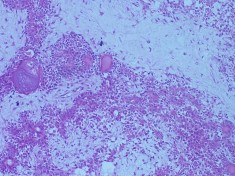 E F Bệnh nhân nam 41 tuổi MP lồi mắt Chẩn đoán MP U hỗn hợp tuyến lệ lành 12