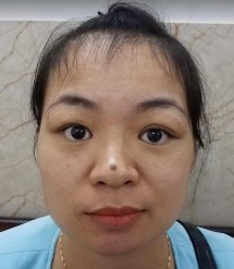 A B C D E F Bệnh nhân nữ 32 tuổi 2M sưng nề mi góc ngoài Chẩn đoán 2M Quá 14