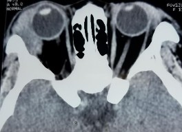 C D E F Bệnh nhân nữ 32 tuổi 2M sưng nề mi góc ngoài Chẩn đoán 2M Quá sản 15