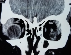 C D E F Bệnh nhân nữ 32 tuổi 2M sưng nề mi góc ngoài Chẩn đoán 2M Quá sản 16
