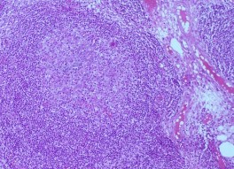 E F Bệnh nhân nữ 32 tuổi 2M sưng nề mi góc ngoài Chẩn đoán 2M Quá sản 17