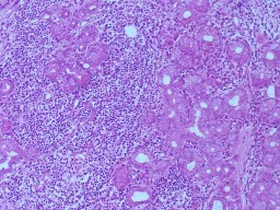 E F Bệnh nhân nữ 32 tuổi 2M sưng nề mi góc ngoài Chẩn đoán 2M Quá sản 18