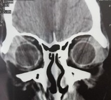 C D E F Bệnh nhân nam 45 tuổi 2M sưng nề mi góc ngoài sờ thấy khối u Bệnh 19