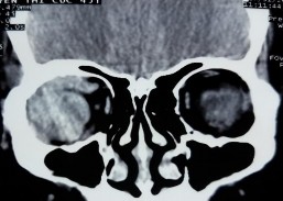 MỘT SỐ HÌNH ẢNH MINH HỌA A B C D E F Bệnh nhân nữ 44 tuổi MP đau nhức lồi 2