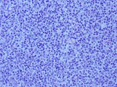 E F Bệnh nhân nam 45 tuổi 2M sưng nề mi góc ngoài sờ thấy khối u Bệnh nhân 20