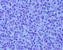 E F Bệnh nhân nam 45 tuổi 2M sưng nề mi góc ngoài sờ thấy khối u Bệnh nhân 21