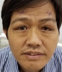 Bệnh nhân nam 45 tuổi 2M sưng nề mi góc ngoài sờ thấy khối u Bệnh nhân sờ 22