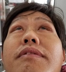 Bệnh nhân nam 45 tuổi 2M sưng nề mi góc ngoài sờ thấy khối u Bệnh nhân sờ 23