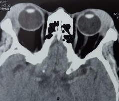 Bệnh nhân nam 45 tuổi 2M sưng nề mi góc ngoài sờ thấy khối u Bệnh nhân sờ 24