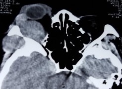 C D E F Bệnh nhân nữ 44 tuổi MP đau nhức lồi mắt phù kết mạc Chẩn đoán 4