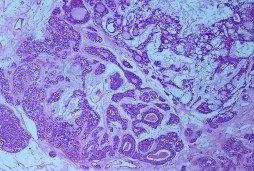 E F Bệnh nhân nữ 44 tuổi MP đau nhức lồi mắt phù kết mạc Chẩn đoán MP 5