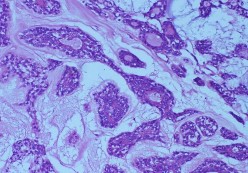 Bệnh nhân nữ 44 tuổi MP đau nhức lồi mắt phù kết mạc Chẩn đoán MP Ung 6