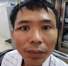 A B C D E F Bệnh nhân nam 41 tuổi MP lồi mắt Chẩn đoán MP U hỗn hợp tuyến 8