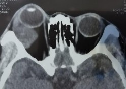 C D E F Bệnh nhân nam 41 tuổi MP lồi mắt Chẩn đoán MP U hỗn hợp tuyến lệ 9