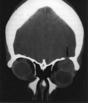 Hình 1 4 Cắt lớp vi tính u hỗn hợp tuyến lệ Mắt trái có hiện tượng mòn 1