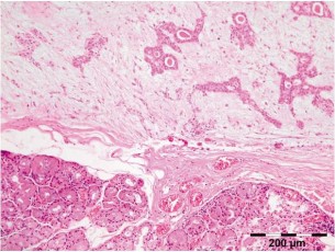 Hình 1 5 Mô bệnh học u hỗn hợp tuyến lệ Các cấu trúc ống được bao quanh 2