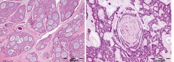 Hình 1 8 Đặc điểm mô bệnh học ung thư biểu mô dạng tuyến nang Nguồn Bartley 3