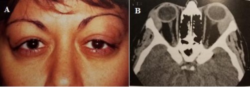 Hình 1 9 Đặc điểm lâm sàng và cắt lớp vi tính quá sản lympho lành tính A 4