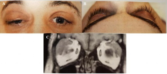 Hình 1 10 U lympho ác tính tuyến lệ A Khối u tuyến lệ hai bên B Lồi mắt 5
