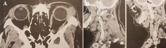 Hình 1 11 Cắt lớp vi tính u lympho ác tính tuyến lệ A Mắt trái có khối u vùng 1