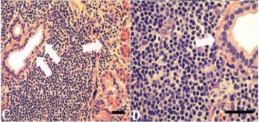 Hình 1 12 Đặc điểm mô bệnh học u lympho ác tính vùng rìa ngoài hạch Nguồn 2