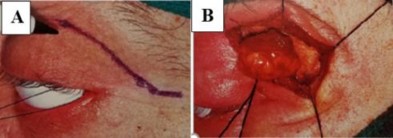 Hình 1 13 Phẫu thuật cắt bỏ u hỗn hợp tuyến lệ A Đường rạch da lấy bỏ 3
