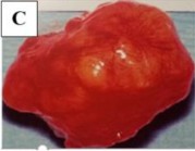 Hình 1 13 Phẫu thuật cắt bỏ u hỗn hợp tuyến lệ A Đường rạch da lấy bỏ 4