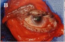 C D Hình 1 14 Phẫu thuật cắt bỏ ung thư biểu mô dạng tuyến nang A Phẫu thuật 5