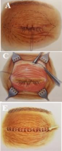Hình 2 4 Nạo vét tổ chức hốc mắt A Có 2 loại kỹ thuật Cắt bỏ mi mắt 1