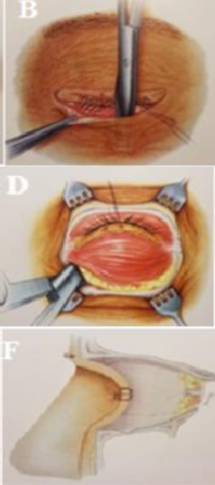 Hình 2 4 Nạo vét tổ chức hốc mắt A Có 2 loại kỹ thuật Cắt bỏ mi mắt 2