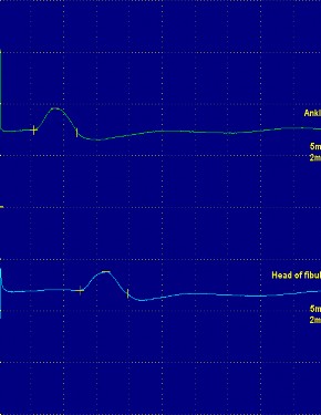 Hình ảnh dẫn truyền vận động của dây thần kinh chày Hình ảnh sóng F của 1