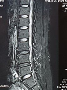 Hình ảnh thoát vị đĩa đệm trên phim chụp MRI 2 Hình ảnh khảo sát dẫn 10