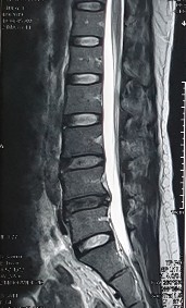 Hình ảnh thoát vị đĩa đệm trên phim chụp MRI 2 Hình ảnh khảo sát dẫn 11