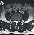 Hình ảnh thoát vị đĩa đệm trên phim chụp MRI 2 Hình ảnh khảo sát dẫn 12