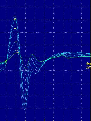 Hình ảnh phản xạ H bị mất Hình ảnh sóng F của dây thần kinh mác nông Hình 13