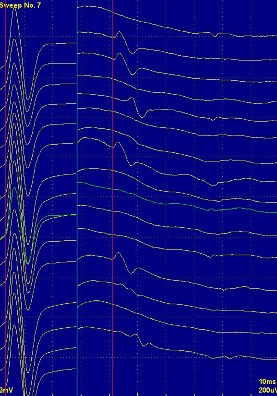 Hình ảnh phản xạ H bị mất Hình ảnh sóng F của dây thần kinh mác nông Hình 14