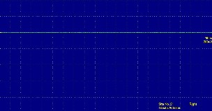 Hình ảnh không có điện thế tự phát tại vị trí cơ chày trước bên phải 15
