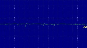 Hình ảnh không có điện thế tự phát tại vị trí cơ chày trước bên phải 16