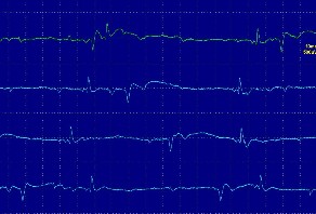 Hình ảnh điện thế tự phát sóng nhọn dương tại cơ cạnh sống chi phối bởi 17