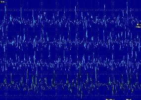 Hình ảnh điện thế tự phát sóng nhọn dương tại cơ cạnh sống chi phối bởi 18